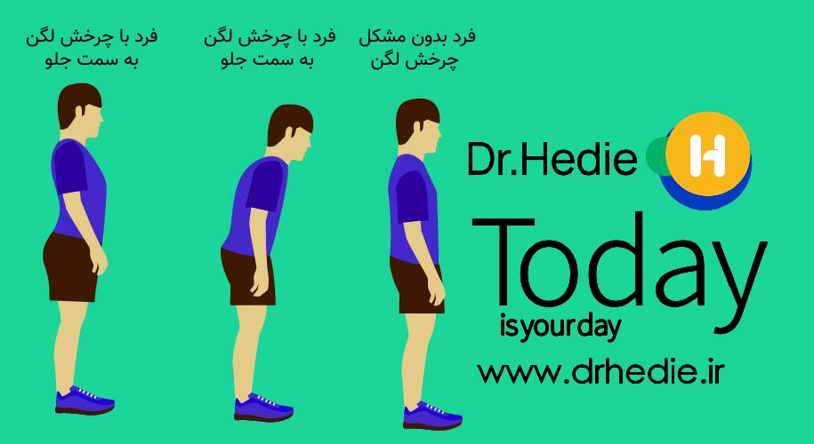 چرخش لگن به جلو، علائم چر خش لگن